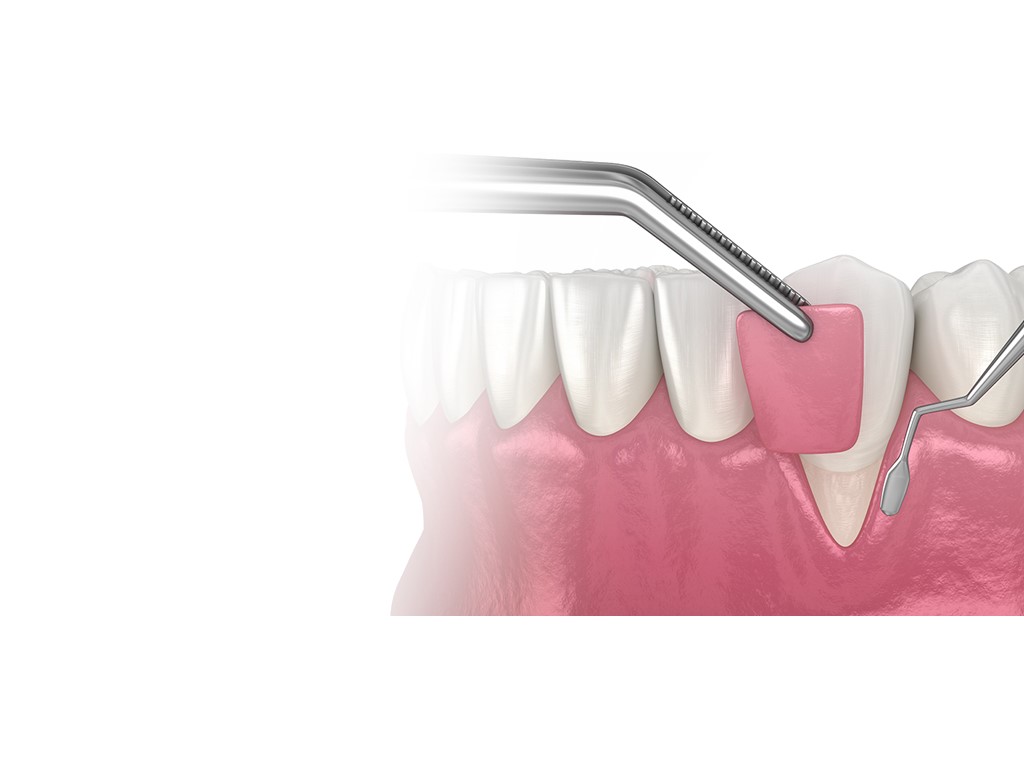 Australia Classifieds Advanced Gum Care at Agrawal Dental Clinic