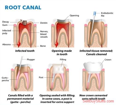 Hyderabad Root Canal Treatment: Procedures and Recovery