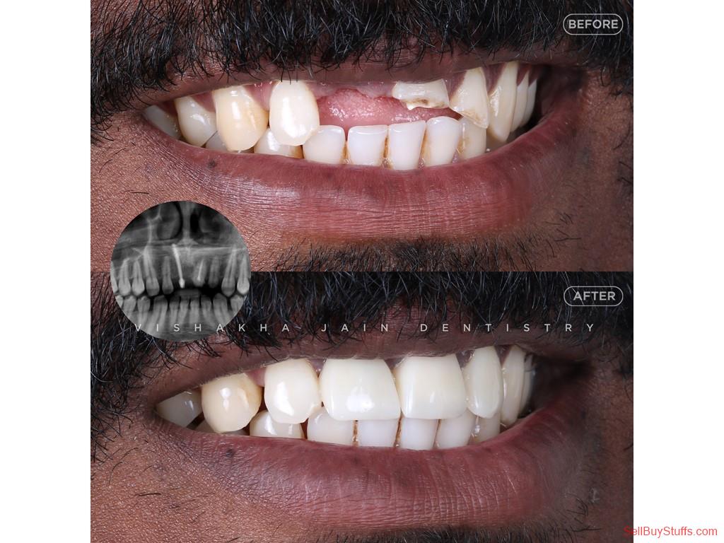 Australia Classifieds Best Dental Clinic in Indore | Advanced Dental Implants, Braces & Smile Makeover
