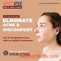 Kurnool facial port wine stain Treatment in india