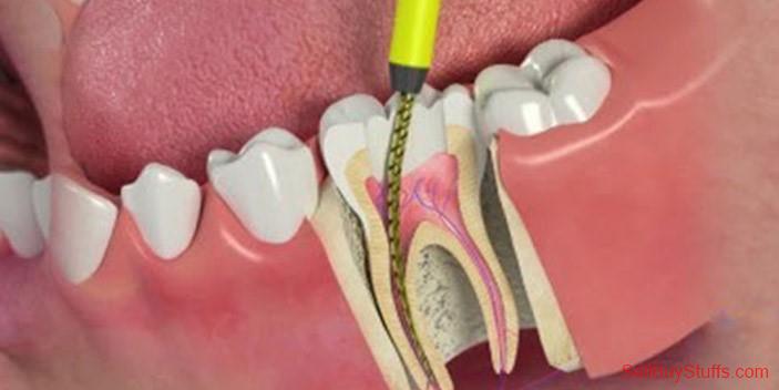 Root Canal Treatment Cost in India