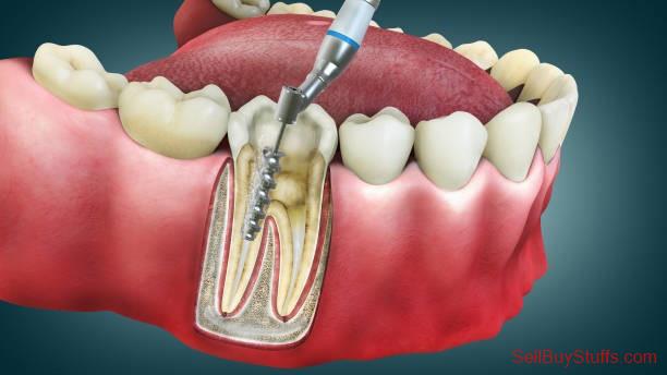 Mumbai Root Canal Cost in Thane | Agrawal Dental Clinic